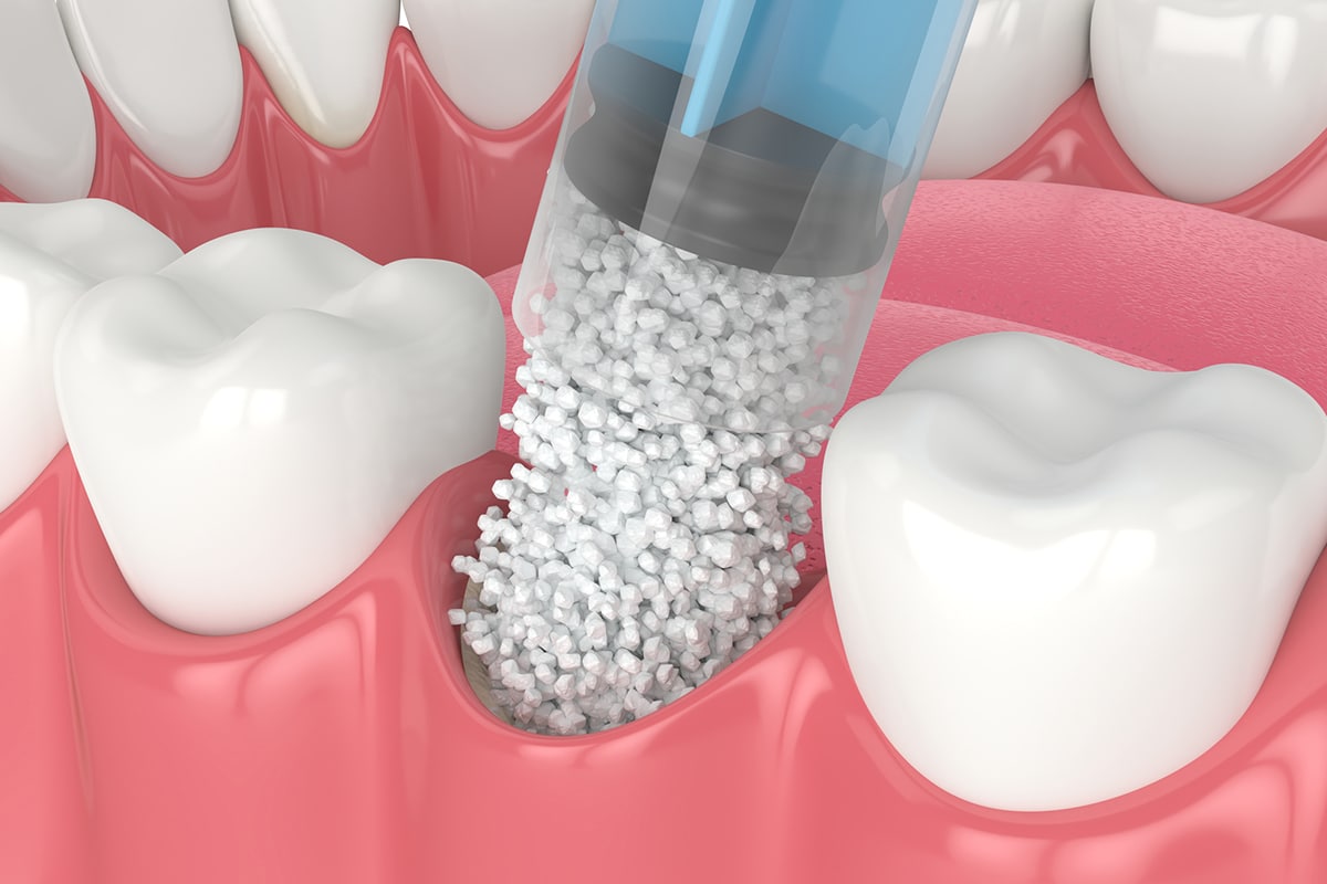 how-much-does-bone-grafting-cost-in-nassau-county-ny