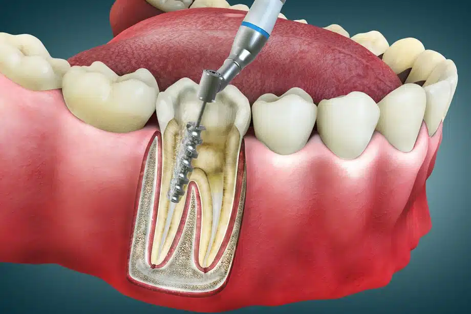 What Can I Eat After A Root Canal?